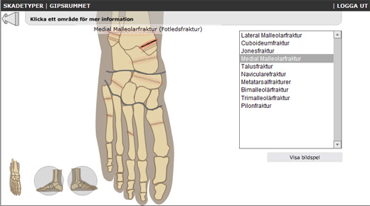 Interaktiv steg-fr-steg anvisning om hur man gipsar olika frakturer